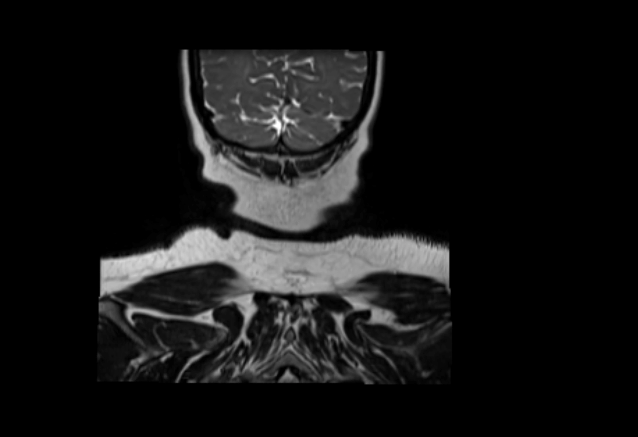 Neck coronal lymph node cross sectional MRI anatomy 3T MRI  image-img-00001-00002.webp